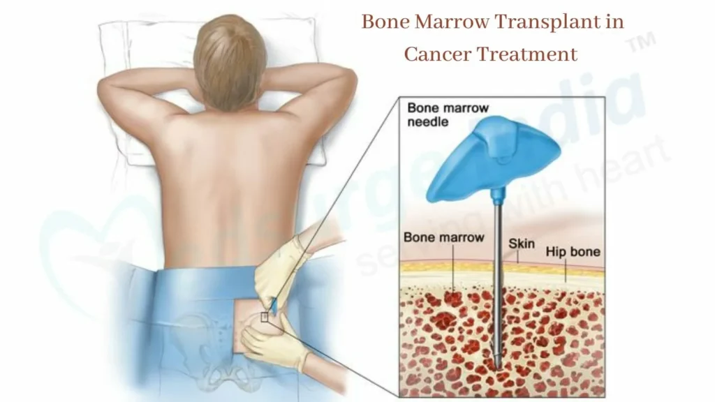 Diagram illustrating a bone marrow transplant procedure in cancer treatment, showing a needle extracting bone marrow from the hip bone beneath the skin."