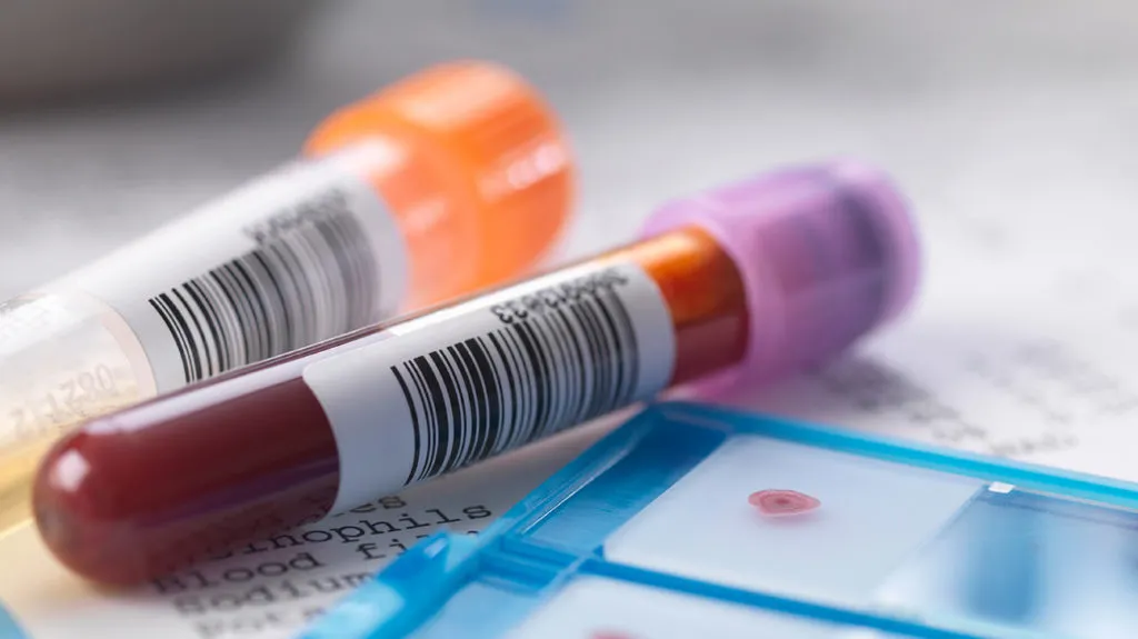A close-up photo of medical test tubes containing blood and other liquids, alongside a microscope slide with a blood sample, in a laboratory setting.