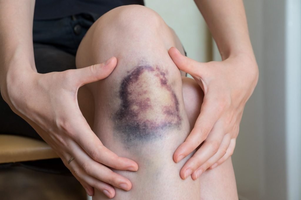 A close-up view of a person's knee with a large, dark purple bruise, with hands gently holding the knee.