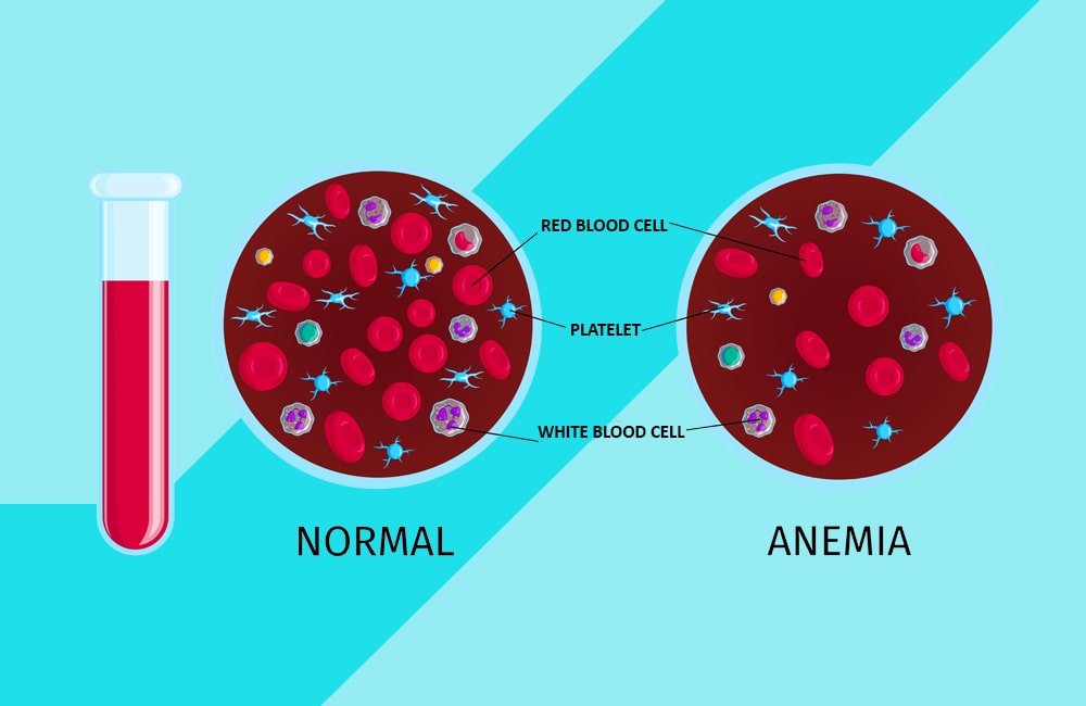 A medical illustration comparing normal blood to anemic blood, showing a test tube of blood and magnified views where the anemic sample has significantly fewer red blood cells.