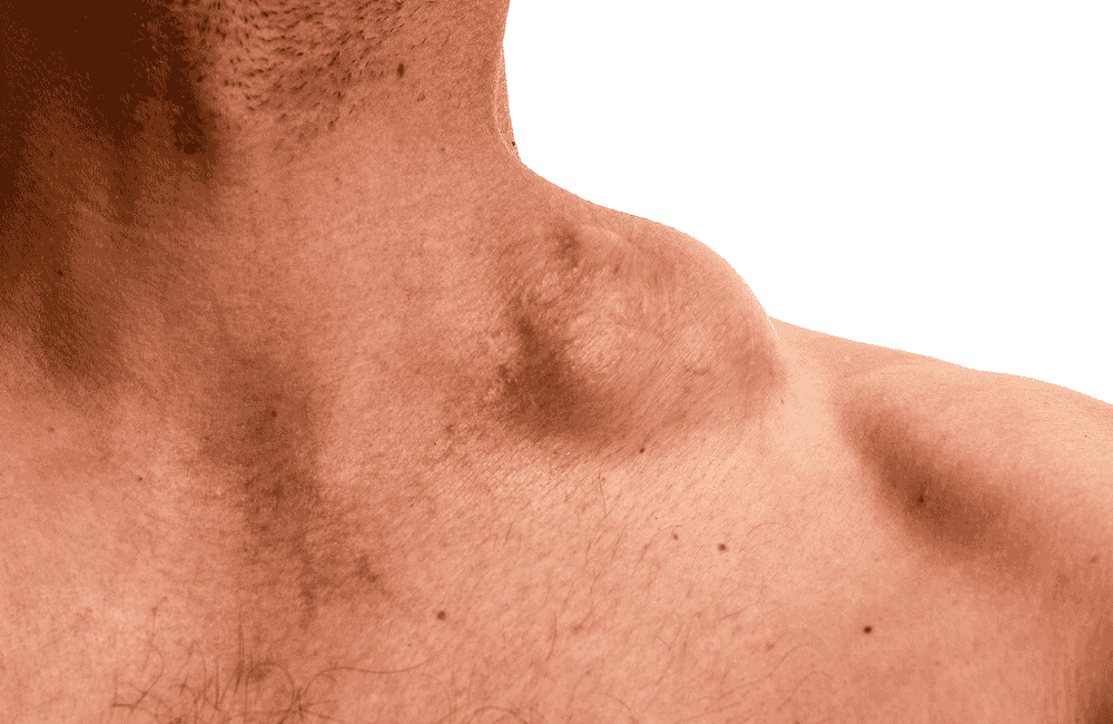 A close-up medical photo showing a raised bump or lump on a person's upper back near the shoulder.